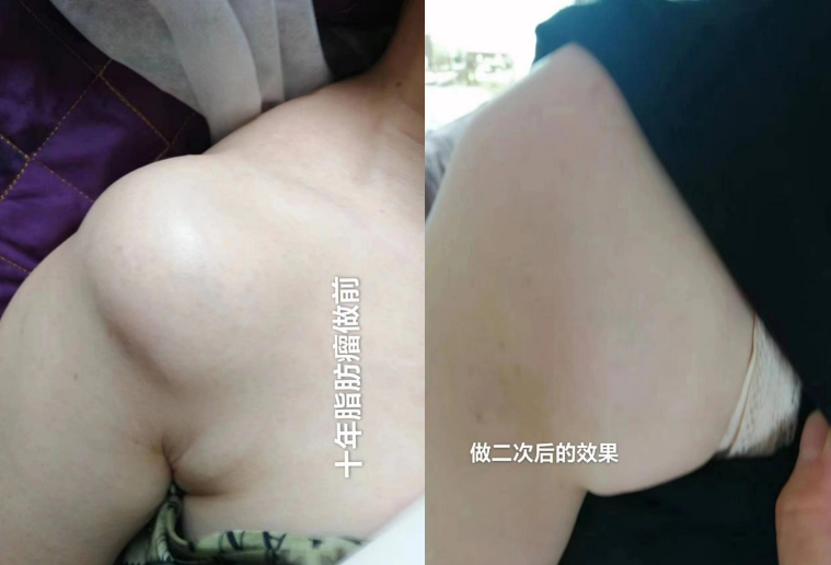 脂肪瘤