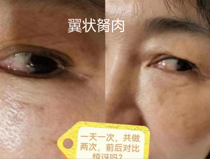 翼状胬肉